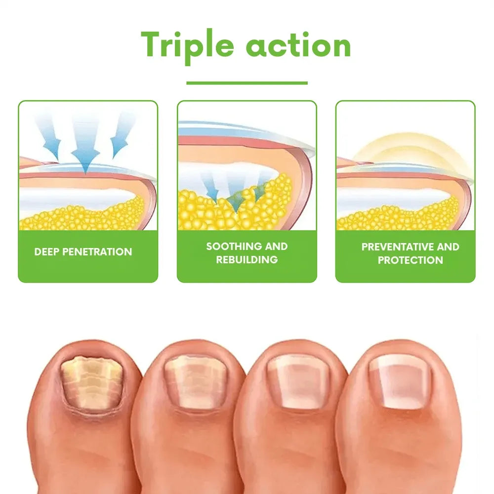 FungiGone® | Kill toenail fungus and bacteria and get healthier nails!