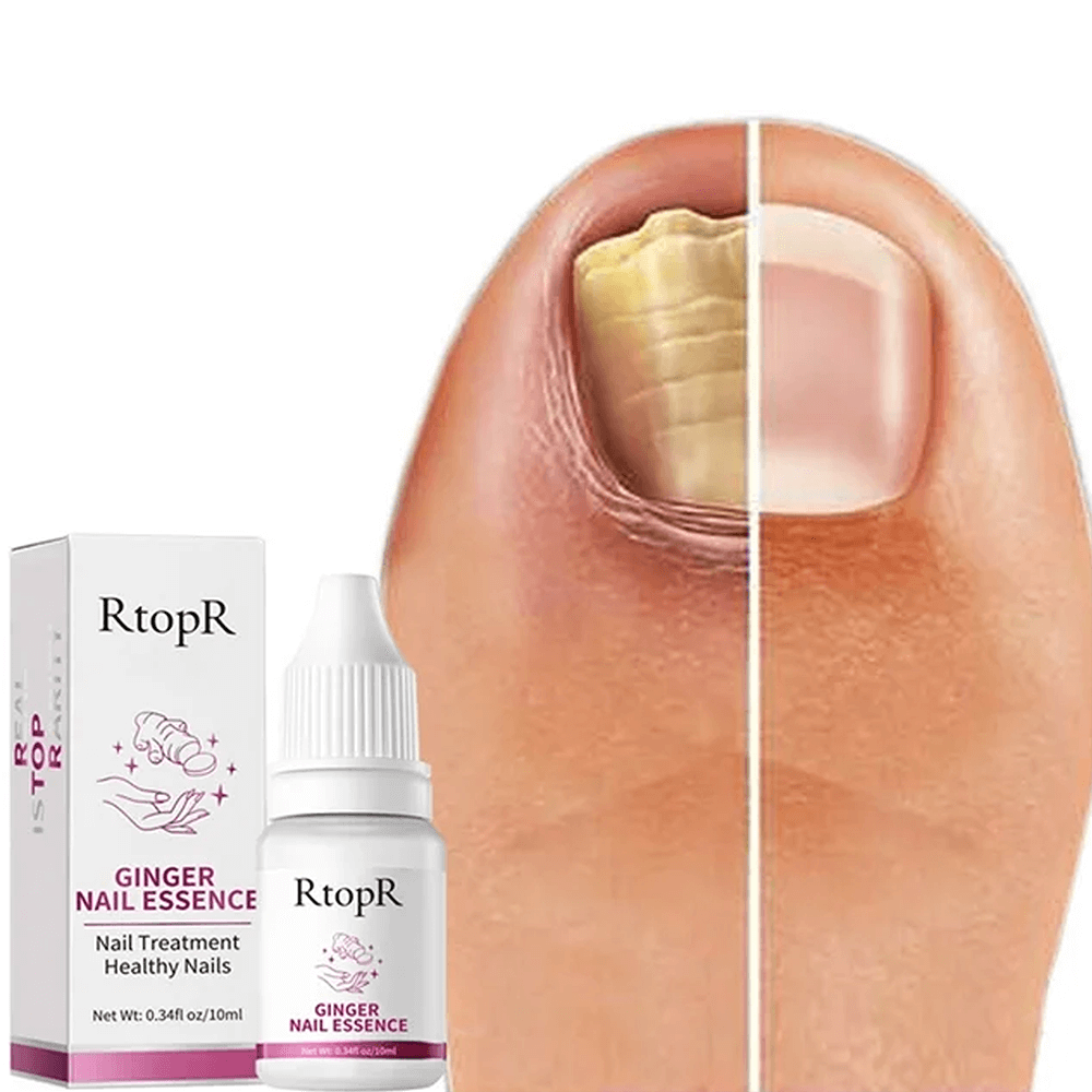 ZeroFungi® - Naturally get rid of your nail & toenail fungi!